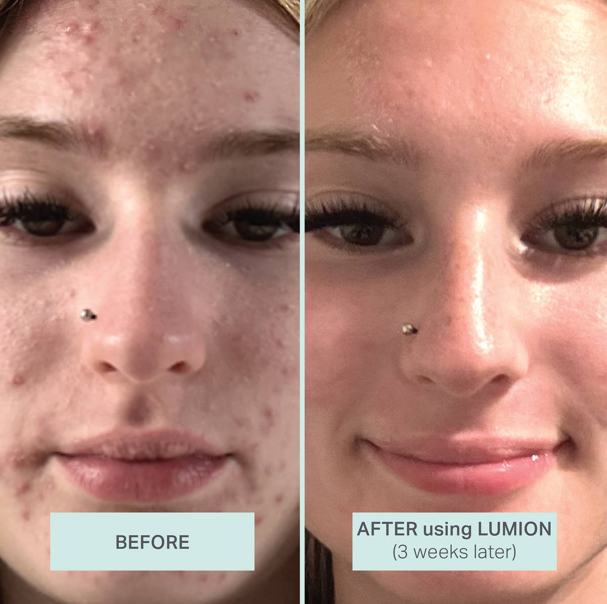 Miracle Mist with Hypochlorous Acid + Oxygen