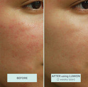 Save My Skin Serum with Hypochlorous Acid + Oxygen